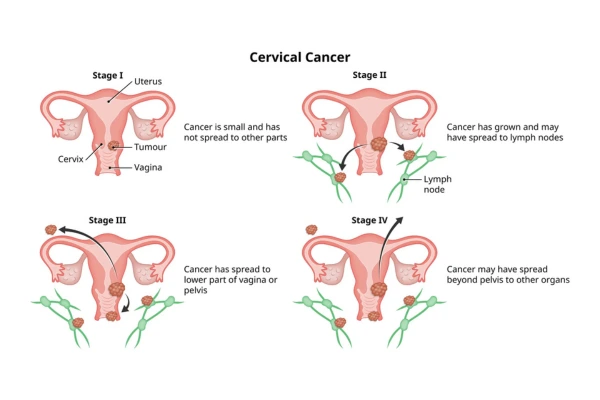 cáncer de cuello uterino