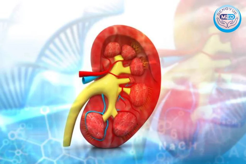 una revolución en el nefropatia por iga tratamento cómo las terapias dirigidas están cambiando el destino de los pacientes