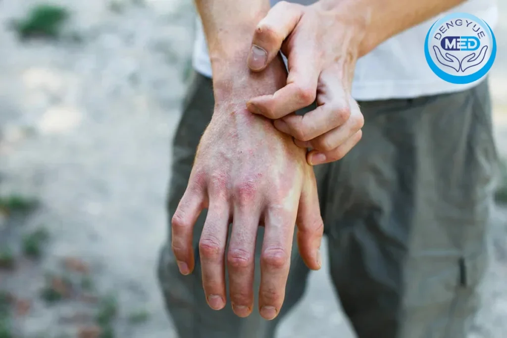 cómo cambia el inhibidor de il-17a secukinumab (cosentyx) las reglas del manejo de la inflamación