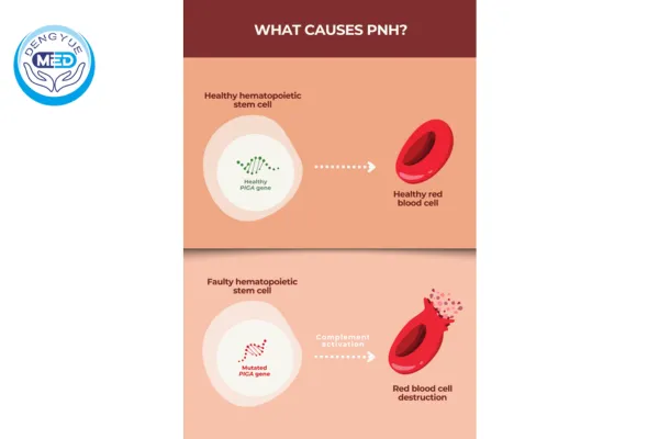 mercado de hpn e inhibidores del complemento