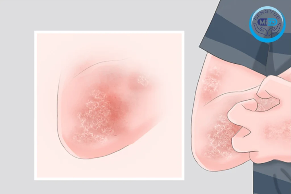 nmpa aprueba la amdokitug injection, un nuevo biológico clave para el tratamiento de la psoriasis en placas moderada a grave